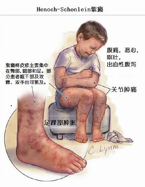 过敏性紫癜的中医治疗